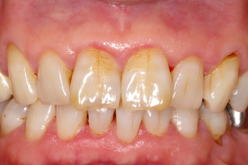 歯 の ひび割れ 症状