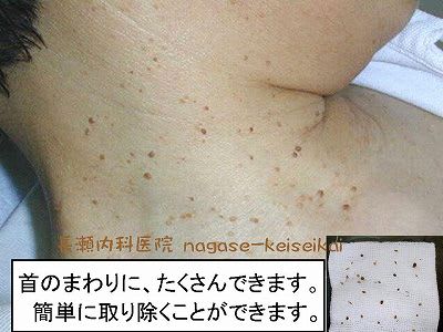 首 の イボ 自分 で 取る 市販 薬