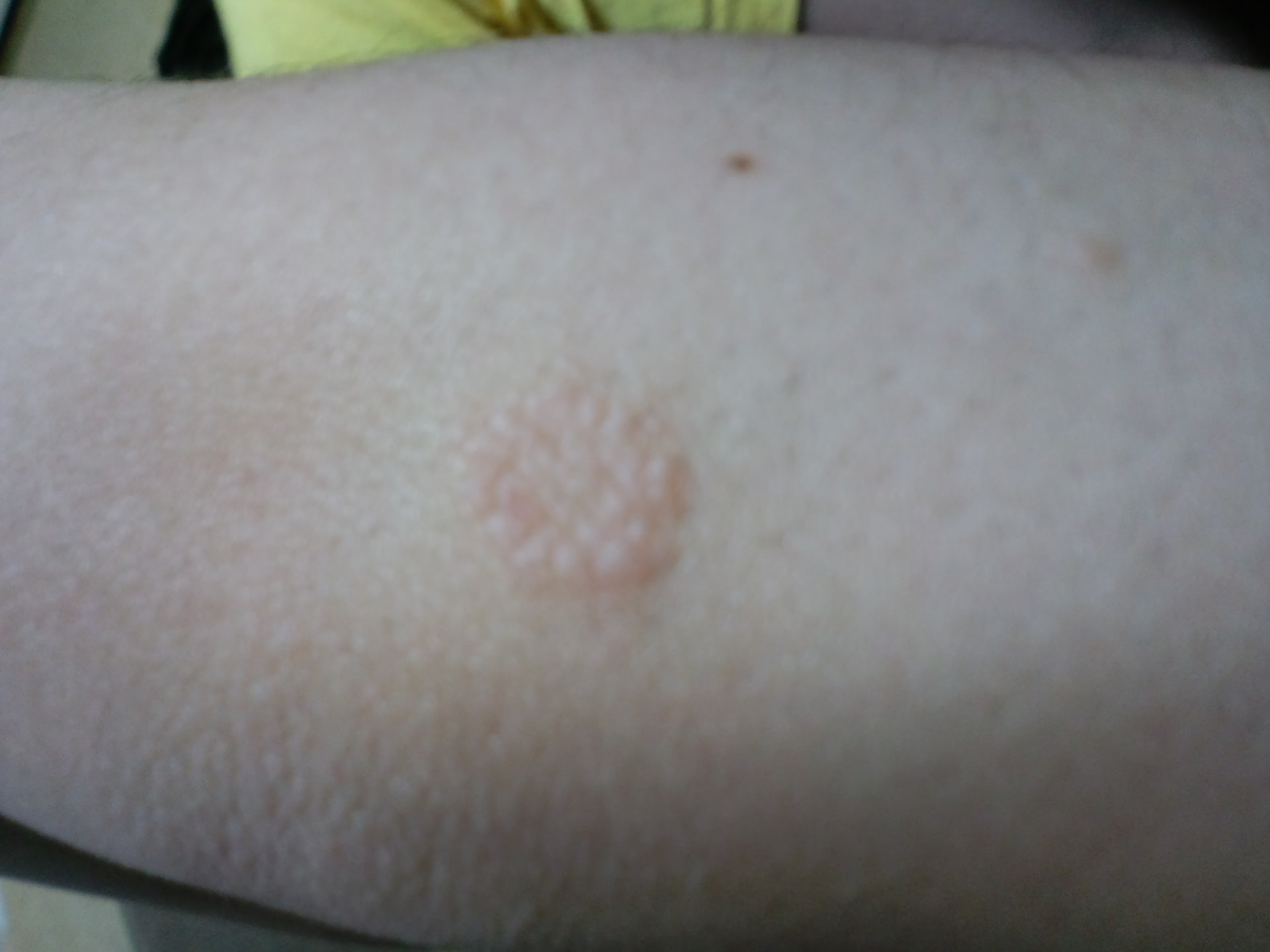 糠 ジベル ばら色 原因 粃 疹 ジベルばら色粃糠疹の原因、症状、治療 再発する？予防できる？｜アスクドクターズトピックス