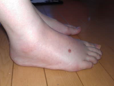 片足 足 むくみ の 甲 脚のむくみ 片脚だけ極端に悪化したら注意