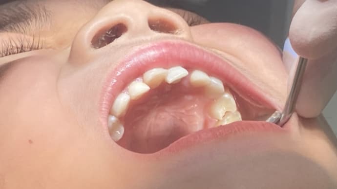 歯が汚い😵