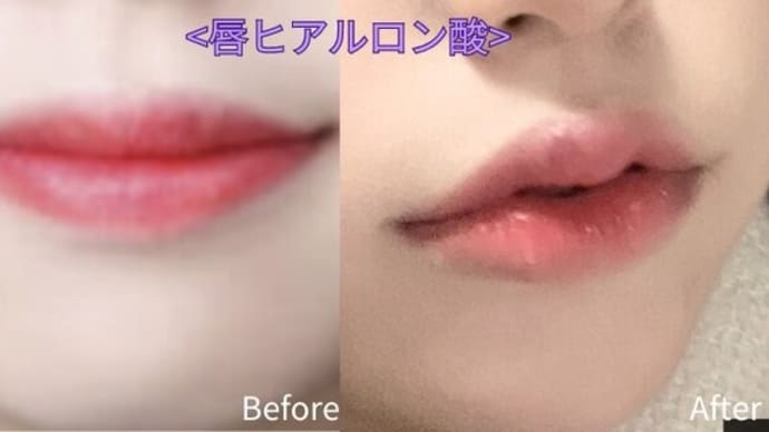 [江南美容皮膚科・整形外科]唇ヒアルロン酸注入症例写真(＋リップフィラーお得情報まで💗)