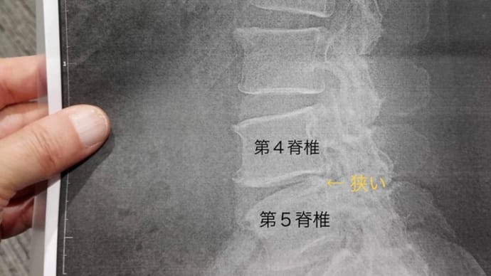 腰痛の原因が判明