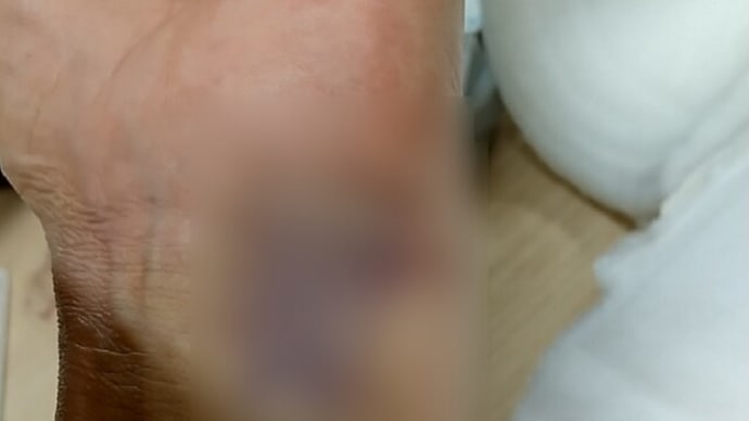 ギプス交換