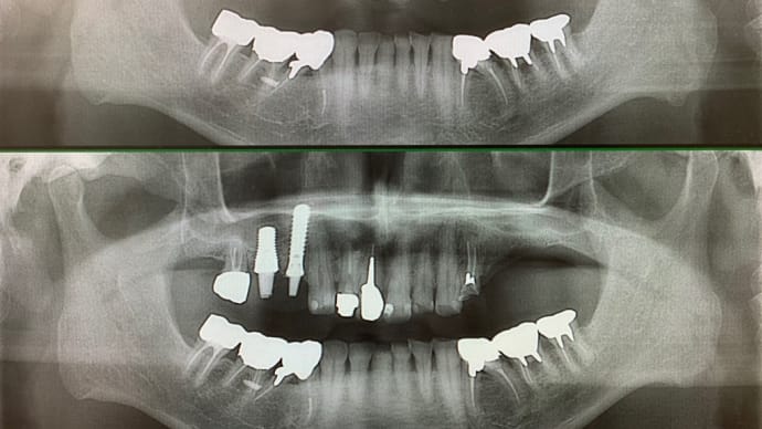 上顎の奥歯に即時荷重インプラント　2年掛かるかも知れない成果を1日で出す