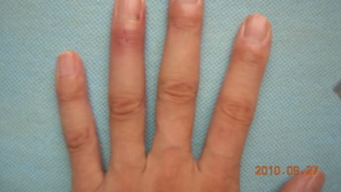 「マレット骨折(マレット・フィンガー)からの復活 その後・・・」