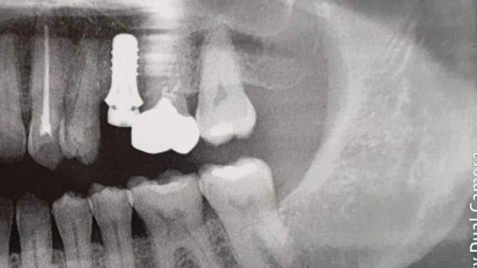 インプラント治療の覚書　