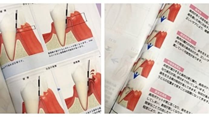 歯の定期検診