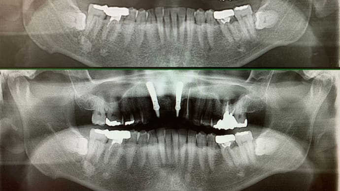 本当に腫れない痛がらせない抜歯即時インプラント、1日で蘇る綺麗な歯