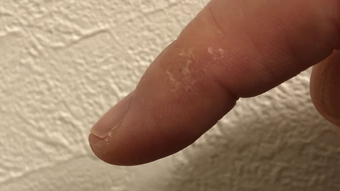 人差し指の角質ガサガサ