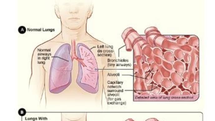 間質性肺疾患：COVID-19 mRNAワクチンによる障害報告のレビュー