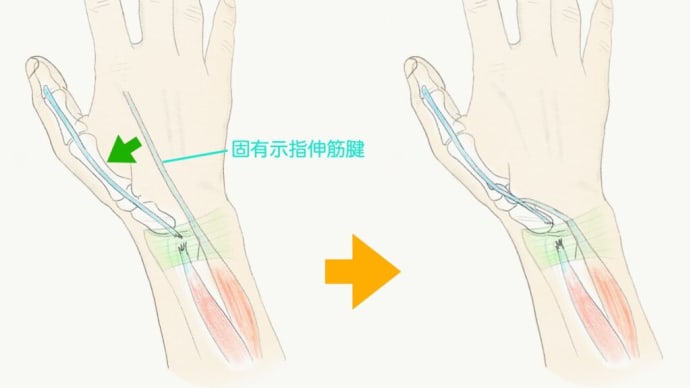 長母指伸筋腱断裂 腱移行術