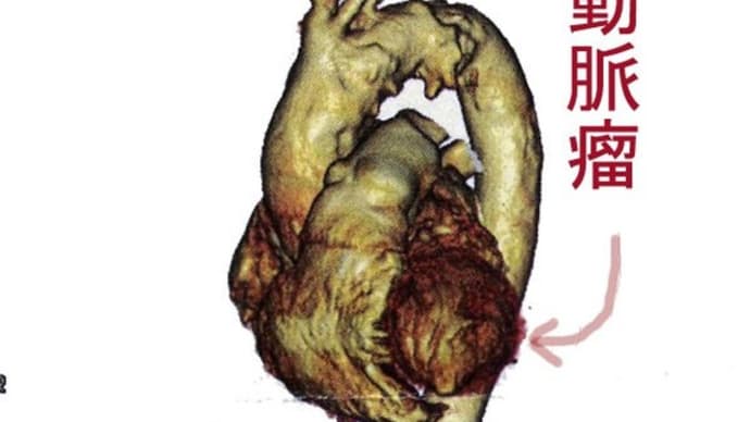 もしあなたが大動脈瘤と言われたら