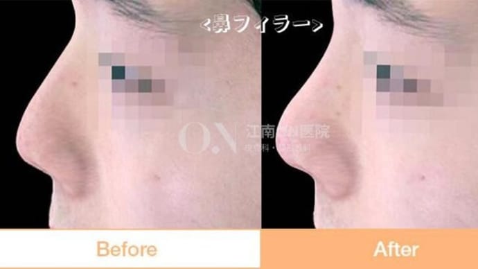 鼻ヒアルロン酸注入 施術前後症例写真のご紹介です🥰