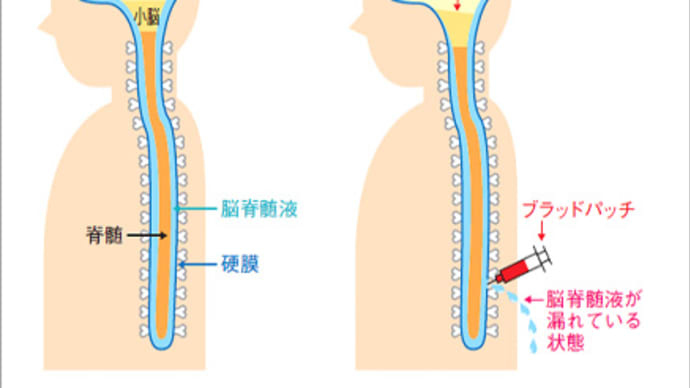 ハッシュタグ 脳脊髄液漏出症 難病 病気 Goo Blog Gooブログ