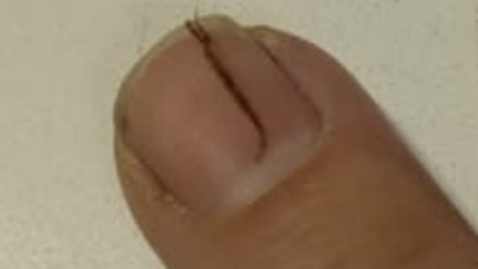 指の痛み　5。