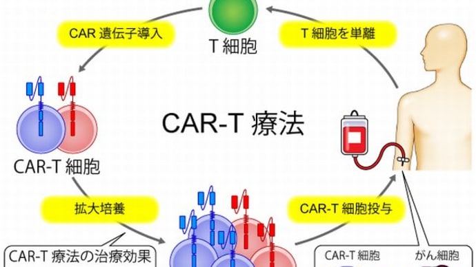 『CARーT細胞』『自己免疫疾患へ応用』『治療高額』