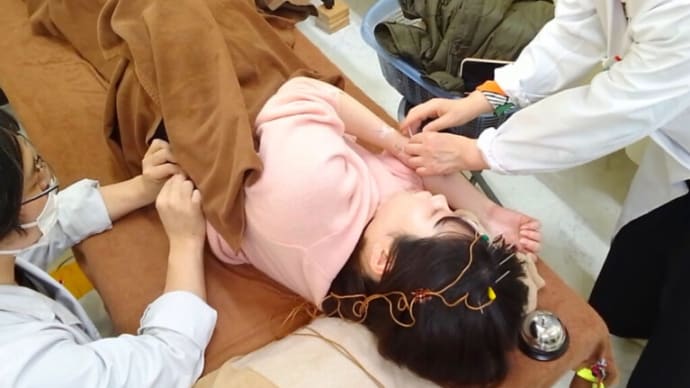 【症例紹介:潰瘍性大腸炎 20代女性 梅谷様】