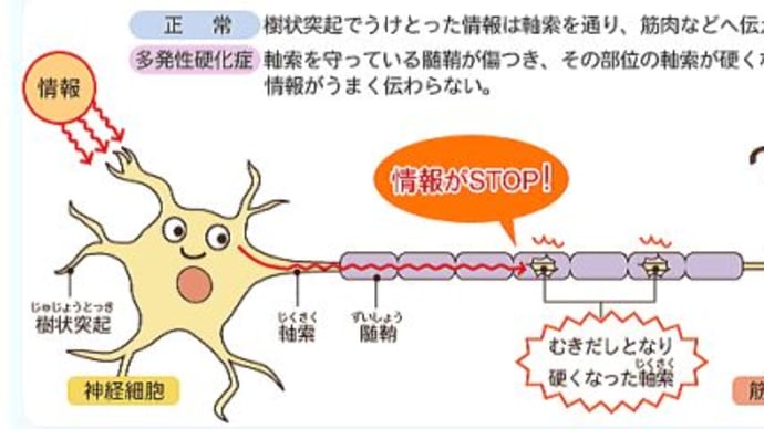 ハッシュタグ 脱髄 ギランバレー 難病 goo blog gooブログ