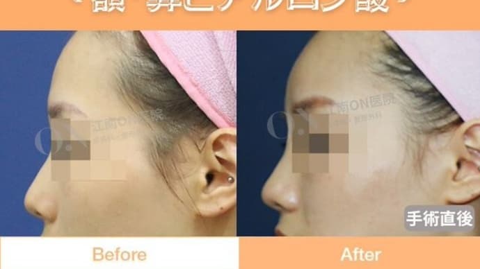 【江南ON医院】洗練された印象になるためには、江南ONでフィラー施術!