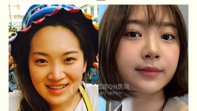 Dr.オミョンジュン 両顎手術症例写真