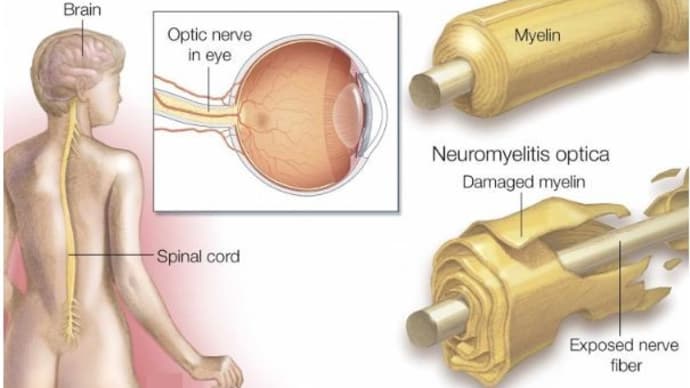 視神経脊髄炎：COVID-19 mRNAワクチンによる障害報告のレビュー