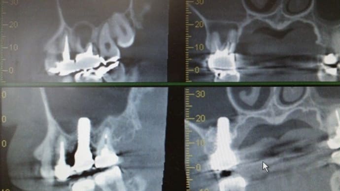 抜歯即時と一緒に骨造りで上顎大臼歯1回限りの手術で治りました。