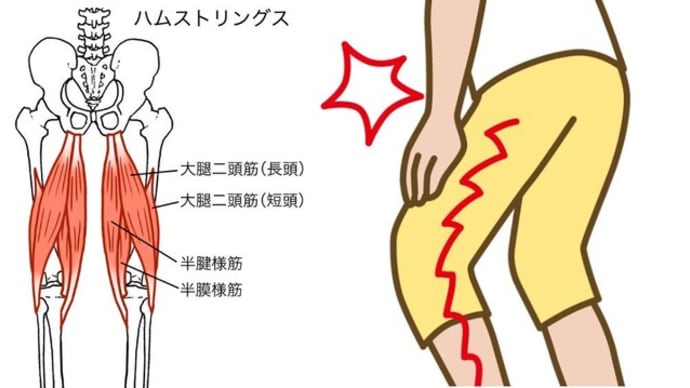 脊柱管狭窄症の治し方:太もも裏の痛みにハムストリングスのセルフケア