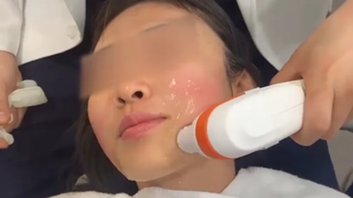 【タイタン徹底解説】インモード、シュリンクの上位機器👀✨タイタン+輪郭注射