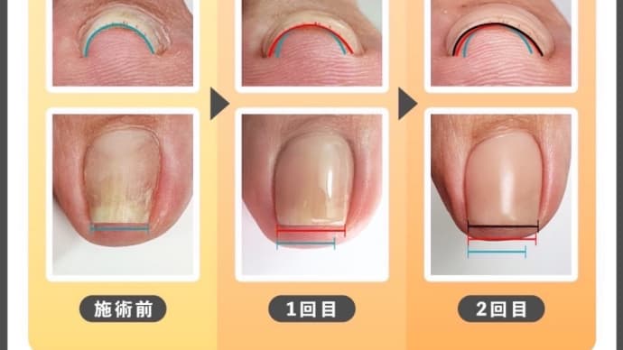 ~巻き爪でお悩みの方必見‼️最新技術✨巻き爪改善ケアご紹介~