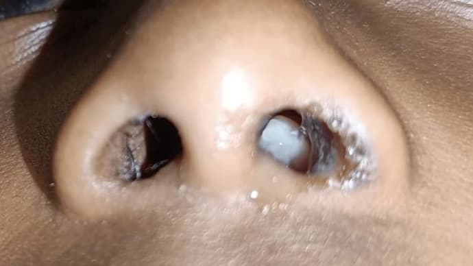 薬物に対する皮膚反応:COVID-19 mRNAワクチンによる障害報告のレビュー