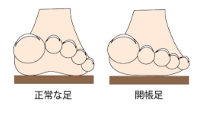 今の時代、多く見られる浮き指状態で歩いている。