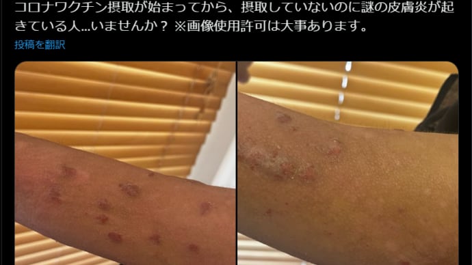 >摂取していないのに謎の皮膚炎が起きている人…いませんか?