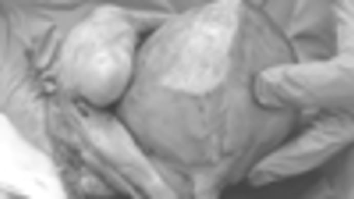 子宮全摘手術のこと。その1。