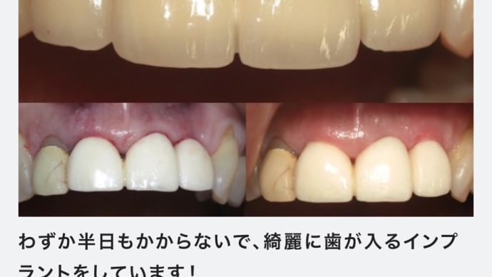 傷の見えない美しい手術後のインプラント治療だから腫れない、痛くない、怖くない