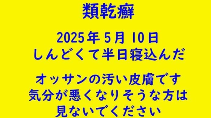 類乾癬です。昨日はとってもしんどかった