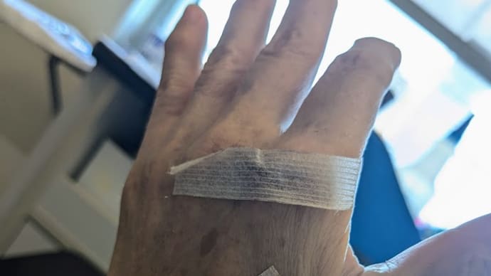スプリンター 長母指伸筋腱皮下断裂手術後
