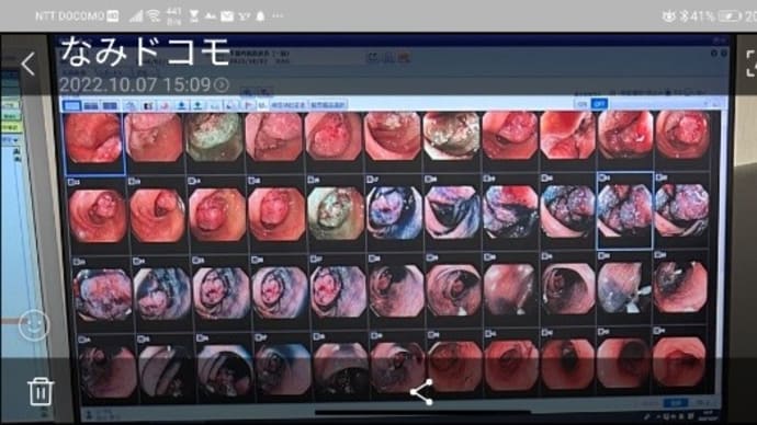 大腸がん併発