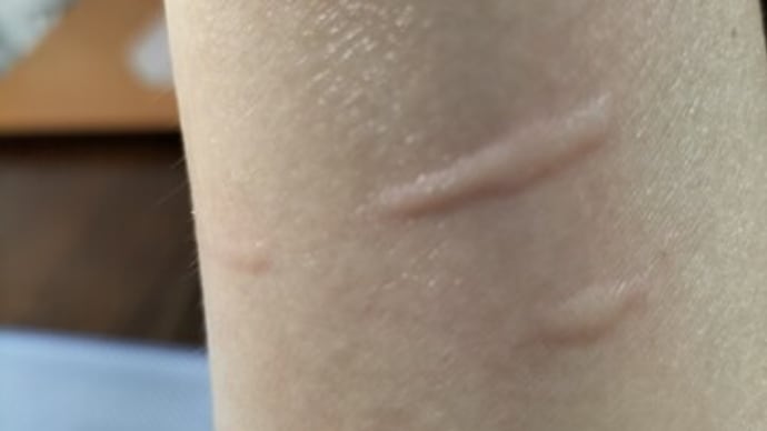 謎のミミズ腫れが頻発する