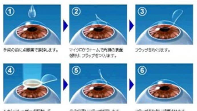 レーシック手術
