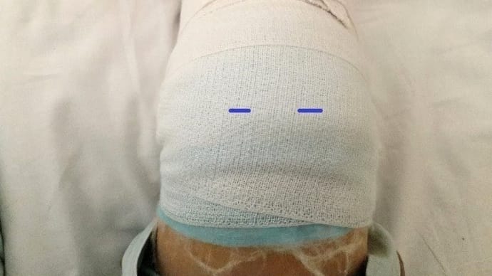 【半月板損傷】手術から1年10カ月が経過しました