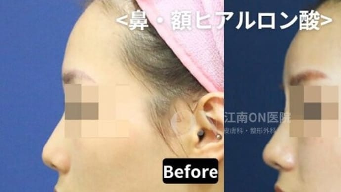 【ヒアルロン酸】江南ON医院イチ押し★フィラー施術★
