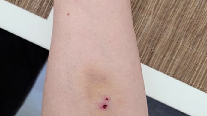 投薬の有無でのお骨の違い(閲覧注意)