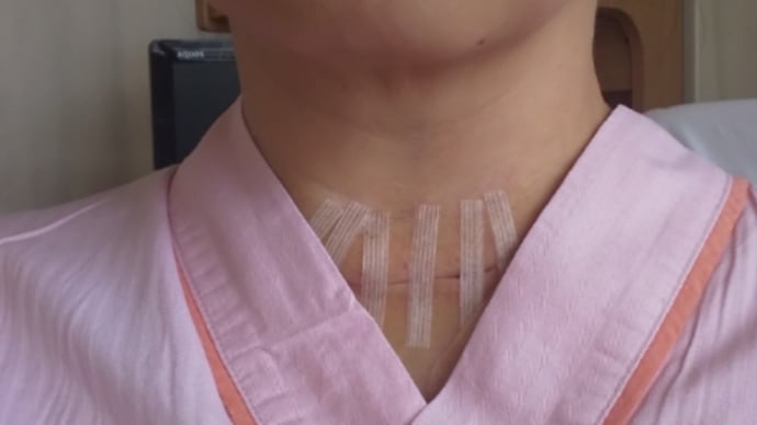甲状腺癌 術後4日目(手術跡の写真注意)