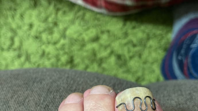 巻き爪治療のハナシ