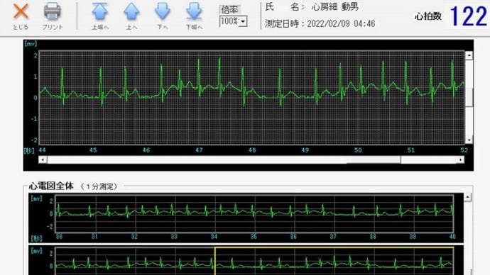 カテアブ後【その四】水曜日の朝4時は心房細動?