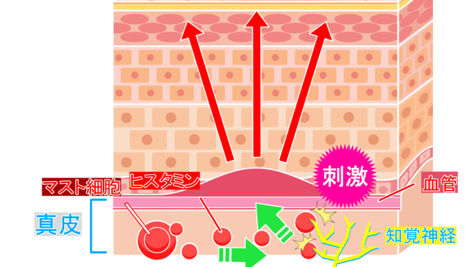 じんましん(蕁麻疹)は突然やってくる