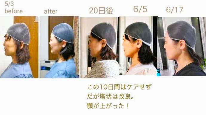 頭コロコロ+太郎孫の施術で、顎のしゃくれが改善!