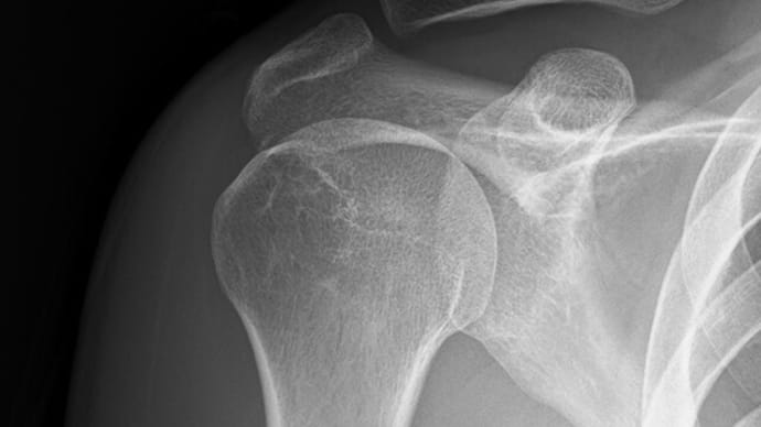 上腕骨近位端骨折後の可動域の重要性
