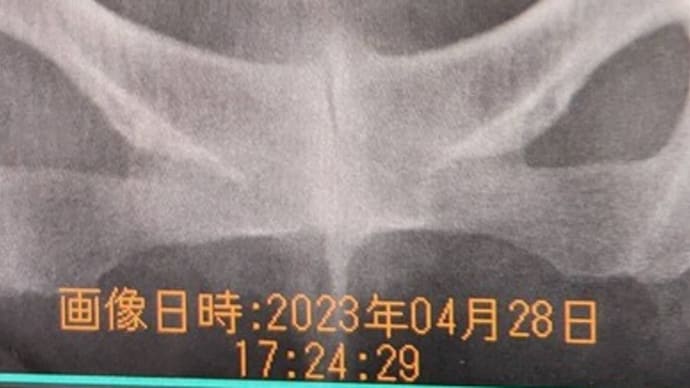 尿路結石からの腎盂炎